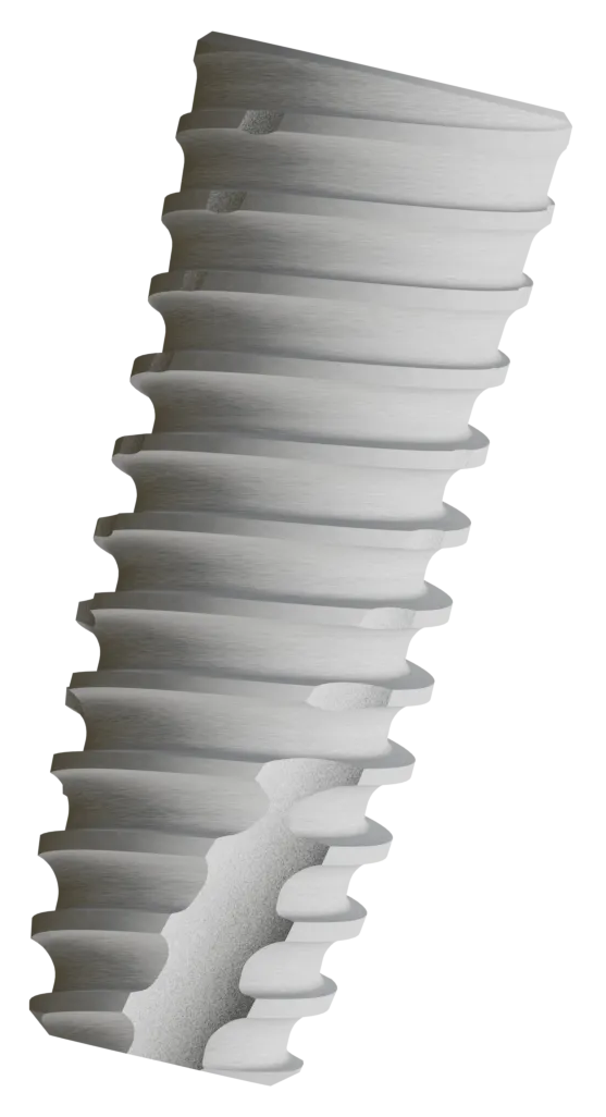 DT implant system